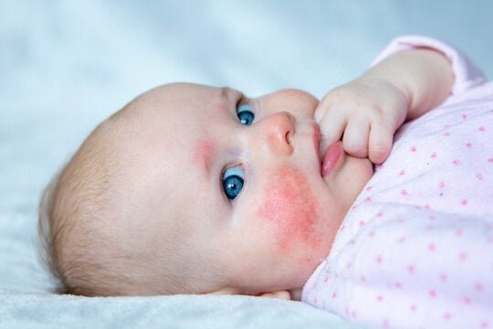 Don’t Buy Baby Eczema Cream Yet: Why Treating the Root Cause Matters More - Zezebaebae