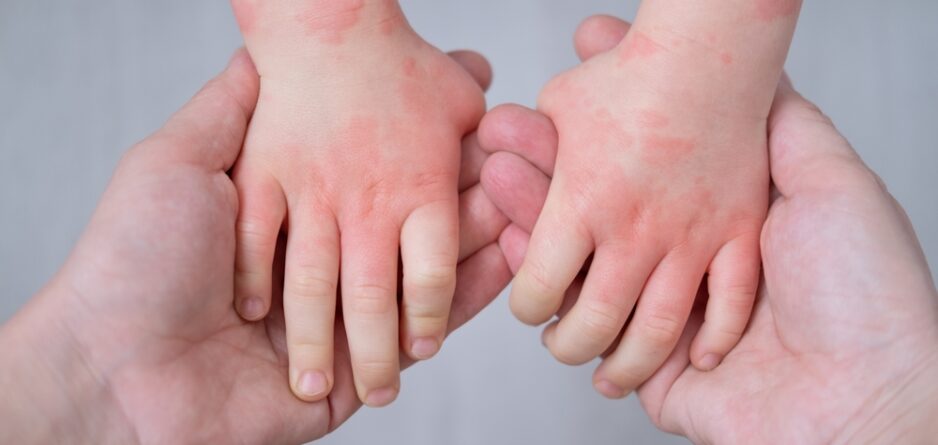 Why is My Baby’s Skin So Sensitive? : Understanding the Probiotic Shower - Zezebaebae